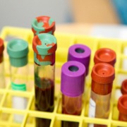 Radiotherapy treatment - blood samples