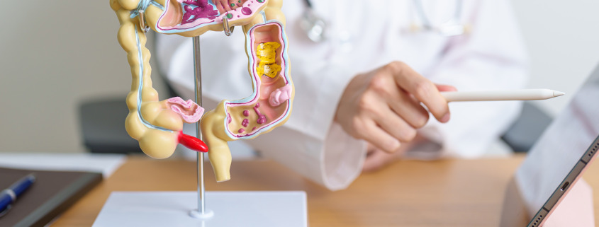 Private radiotherapy - Doctor with human Colon anatomy model